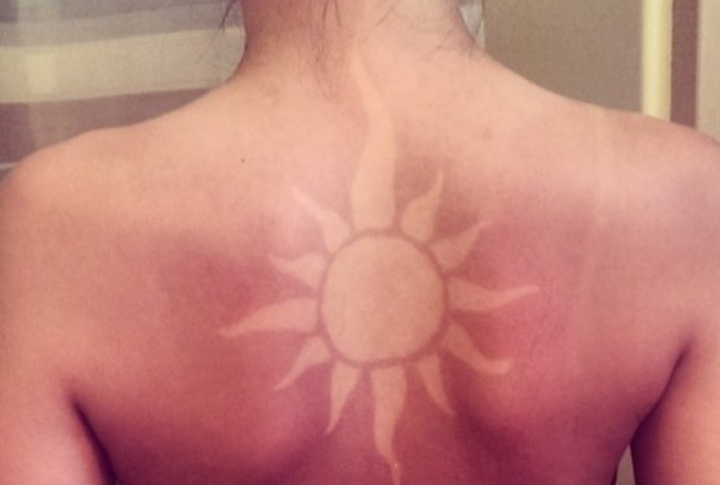 Die "Sunburn-Tattoo-Challenge"
